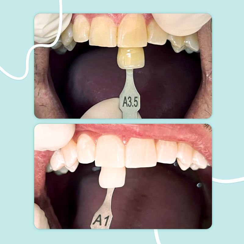 Uma novidade na implantodontia moderna.
